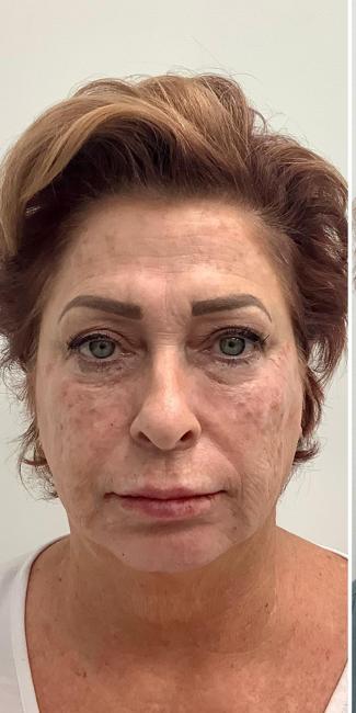 Skincredible 360 Before & After Patient #2909