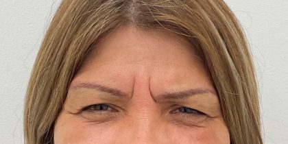 Botox Before & After Patient #2990