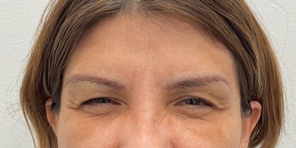 Botox Before & After Patient #2990