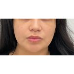 Facial Fillers Before & After Patient #3034