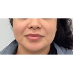 Facial Fillers Before & After Patient #3034