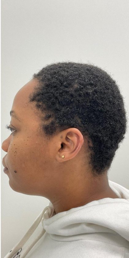 Keloid Removal Before & After Patient #2994