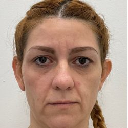 Otoplasty Before & After Patient #3095