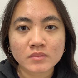 Acne Scar Removal Before & After Patient #3088