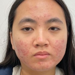 Acne Scar Removal Before & After Patient #3088