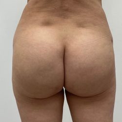 Fat Transfer Before & After Patient #3080