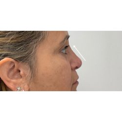 Non-Surgical Rhinoplasty Before & After Patient #3126