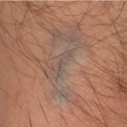 Laser Tattoo Removal Before & After Patient #3157