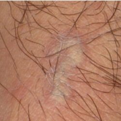Laser Tattoo Removal Before & After Patient #3157