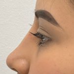 Mole Removal Before & After Patient #3141
