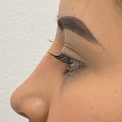 Mole Removal Before & After Patient #3141
