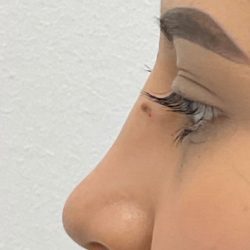 Mole Removal Before & After Patient #3141