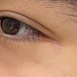 Mole Removal Before & After Patient #3140