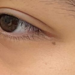 Mole Removal Before & After Patient #3140