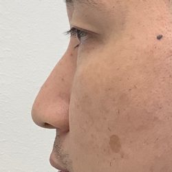 Non-Surgical Rhinoplasty Before & After Patient #3164