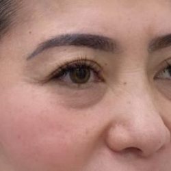 Under Eye Fillers Before & After Patient #3161