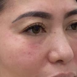 Under Eye Fillers Before & After Patient #3161