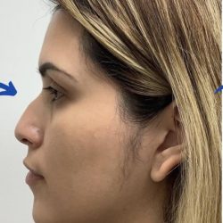 Non-Surgical Rhinoplasty Before & After Patient #3192