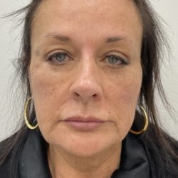 Full Face Enhancement (Botox + Filler Treatment) Before & After Patient #3177
