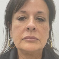 Full Face Enhancement (Botox + Filler Treatment) Before & After Patient #3177