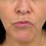 Lip Fillers Before & After Patient #3198