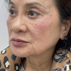 Full Face Enhancement (Botox + Filler Treatment) Before & After Patient #3180