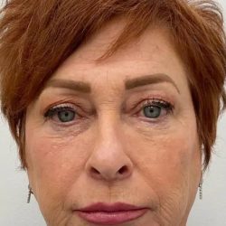 Full Face Enhancement (Botox + Filler Treatment) Before & After Patient #3181