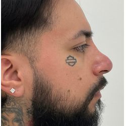 Non-Surgical Rhinoplasty Before & After Patient #3345