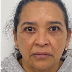 Lower Blepharoplasty Before & After Patient #3351