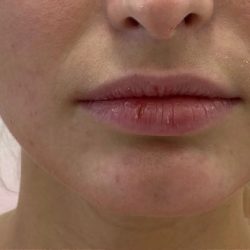 Lip Fillers Before & After Patient #3388