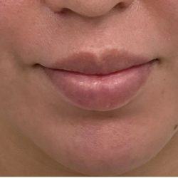 Lip Fillers Before & After Patient #3383