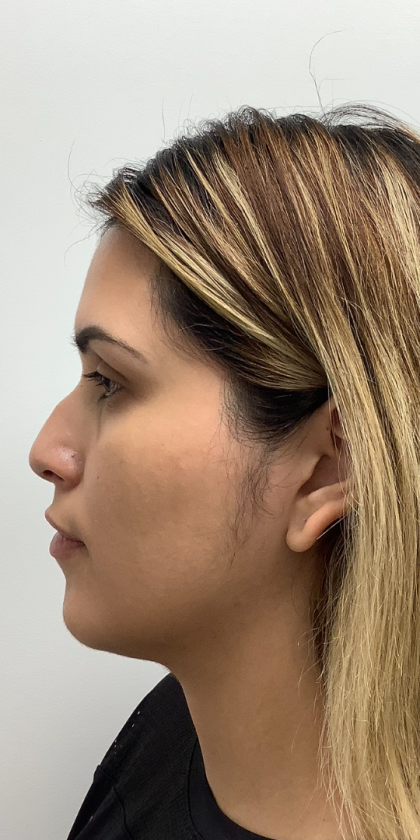 Non-Surgical Rhinoplasty Before & After Patient #3442