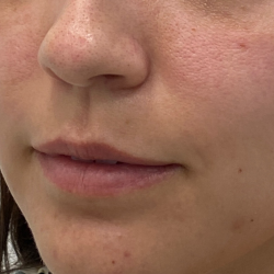 Lip Fillers Before & After Patient #3457