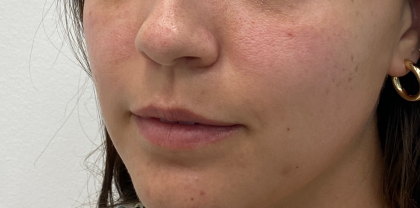 Lip Fillers Before & After Patient #3457