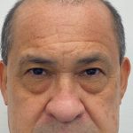 Lower Blepharoplasty Before & After Patient #3460