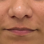 Lip Fillers Before & After Patient #3454