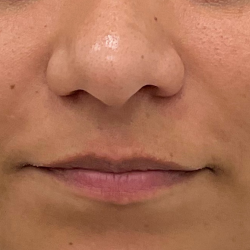 Lip Fillers Before & After Patient #3454