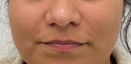 Lip Fillers Before & After Patient #3454