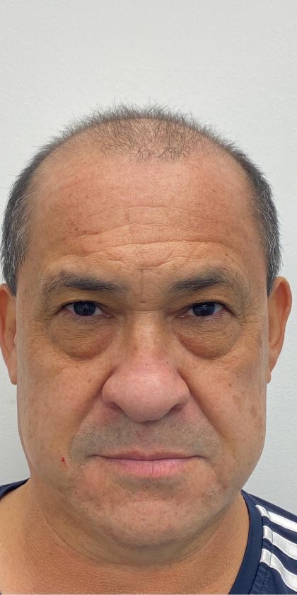 Lower Blepharoplasty Before & After Patient #3460