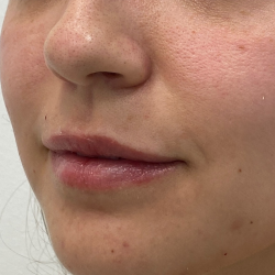 Lip Fillers Before & After Patient #3457