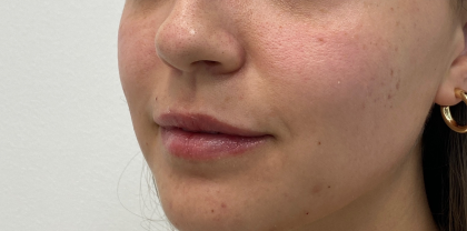 Lip Fillers Before & After Patient #3457