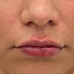 Lip Fillers Before & After Patient #3454