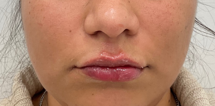 Lip Fillers Before & After Patient #3454