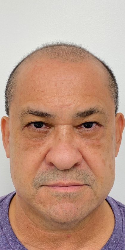 Lower Blepharoplasty Before & After Patient #3460