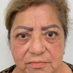 Lower Blepharoplasty Before & After Patient #3478