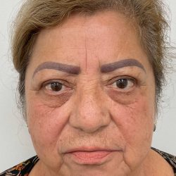 Lower Blepharoplasty Before & After Patient #3478