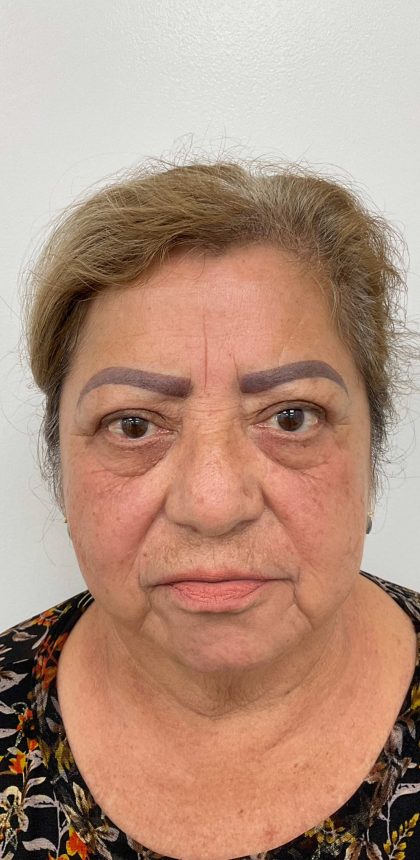Lower Blepharoplasty Before & After Patient #3478