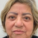 Lower Blepharoplasty Before & After Patient #3478