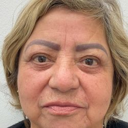 Lower Blepharoplasty Before & After Patient #3478