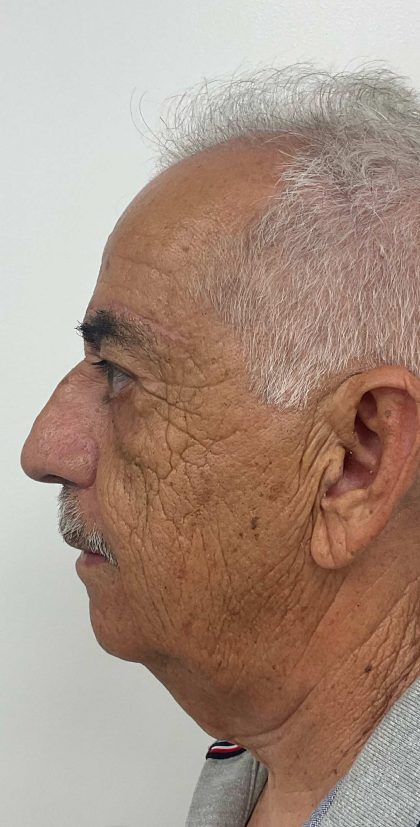 Brow Lift Before & After Patient #3467